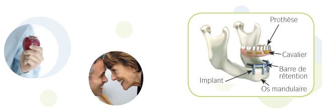 Main tenant une pomme, couple souriant, prothèse amovible sur implants