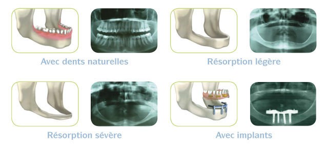 La résorption des os de la mâchoire